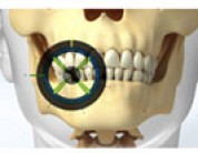 Advances in Dental Technology Make Implants Safer Than Ever