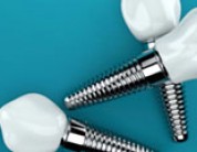 Read more about the article Eight Things to Know Before Getting Dental Implants – Dental Implant FAQs